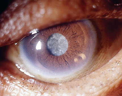 Homeopathic solutions for Eye Treatment