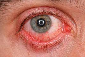 Homeopathic solutions for Eye Treatment