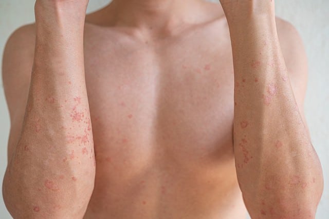 Homeopathic solutions for Skin Disorders