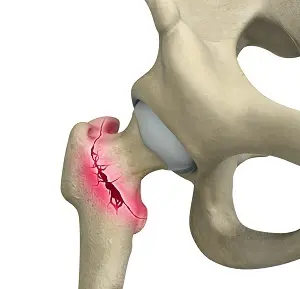 Homeopathic solutions for Orthopaedic Disorder