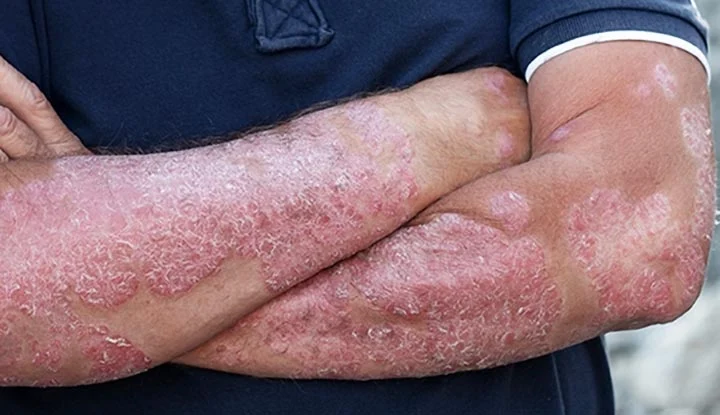 Homeopathic solutions for Skin Disorders
