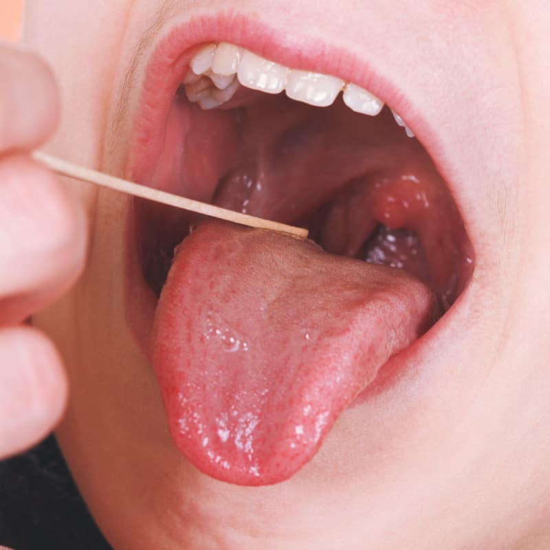 Homeopathic solutions for Tonsils Treatment